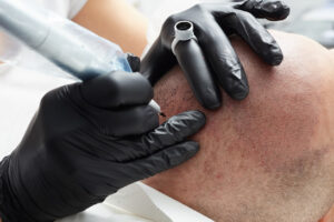 Scalp Micropigmentation - Balding Naturally from Permanently Beautiful LLC in Missoula Montana