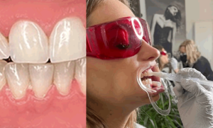Teeth Whitening from Permanently Beautiful in Missoula Montana